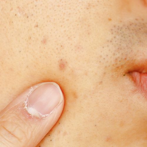 Acne Scar