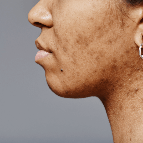 Melasma & Pigmentation