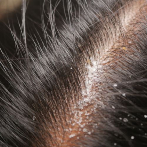 Dandruff & Hair Falls