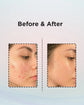 Anti Acne Cream